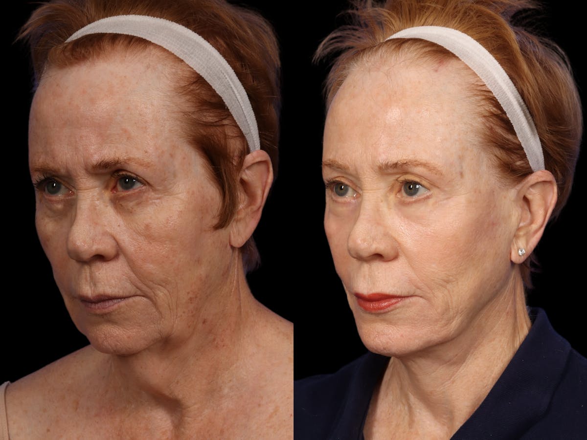 Facelift Before & After Gallery - Patient 296113 - Image 3