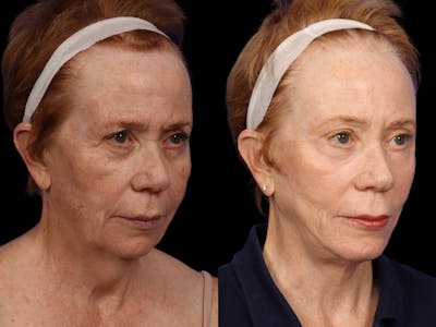 Facelift Before & After Gallery - Patient 296113 - Image 4