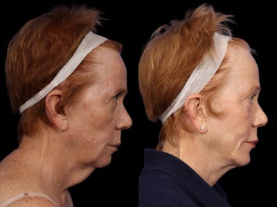 Facelift Before & After Gallery - Patient 296113 - Image 5