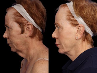 Facelift Before & After Gallery - Patient 296113 - Image 6