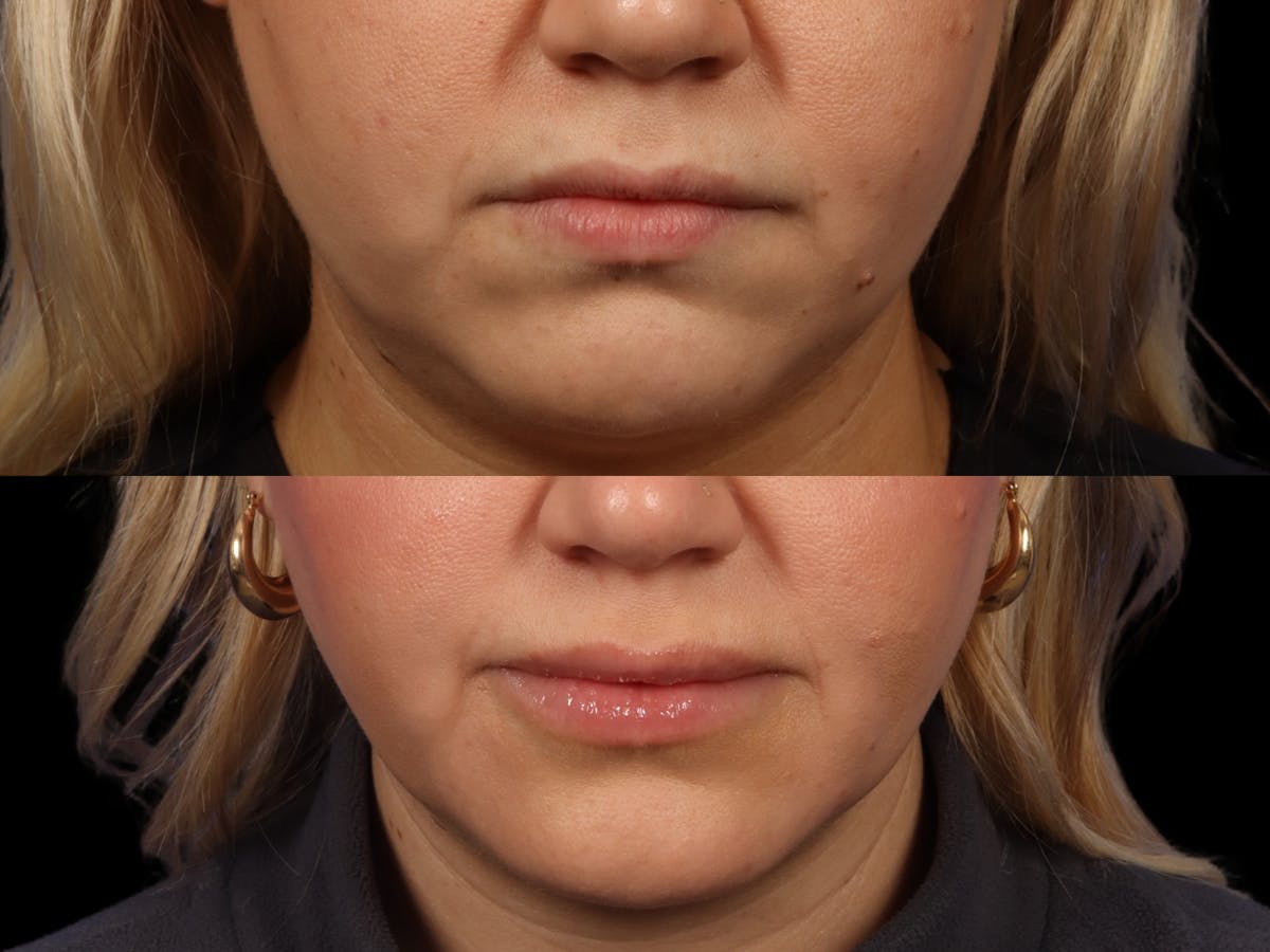 Fillers Before & After Gallery - Patient 292027 - Image 1
