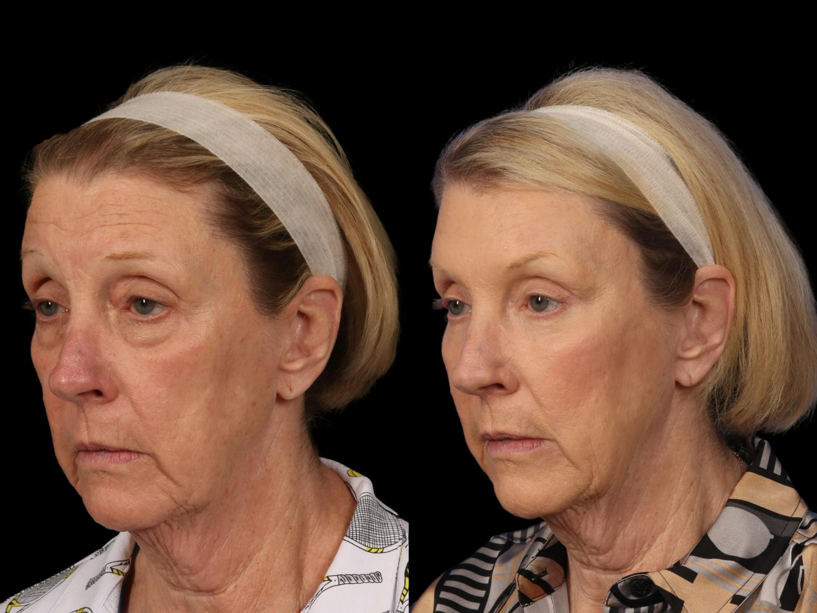 Mid Facelift Before & After Gallery - Patient 365785 - Image 2