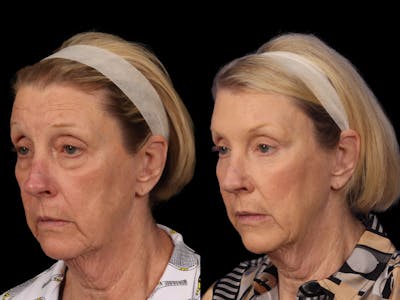 Mid Facelift Before & After Gallery - Patient 365785 - Image 2