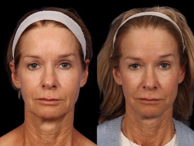 Liposculpture Before & After Gallery - Patient 332917 - Image 1