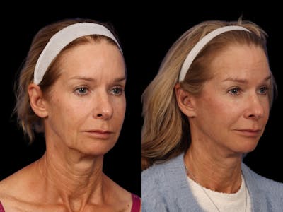 Liposculpture Before & After Gallery - Patient 332917 - Image 2