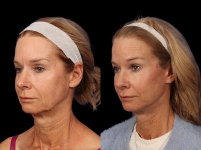 Liposculpture Before & After Gallery - Patient 332917 - Image 3