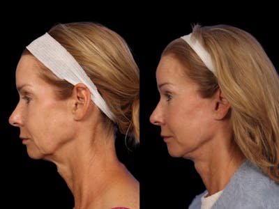 Liposculpture Before & After Gallery - Patient 332917 - Image 4