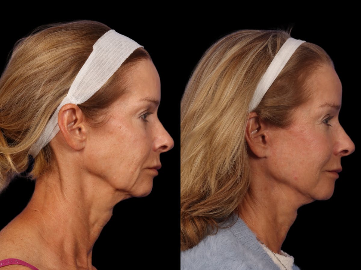 Liposculpture Before & After Gallery - Patient 332917 - Image 5