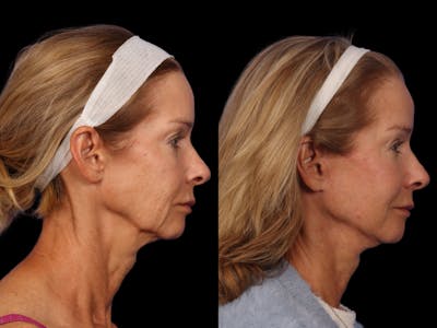 Liposculpture Before & After Gallery - Patient 332917 - Image 5