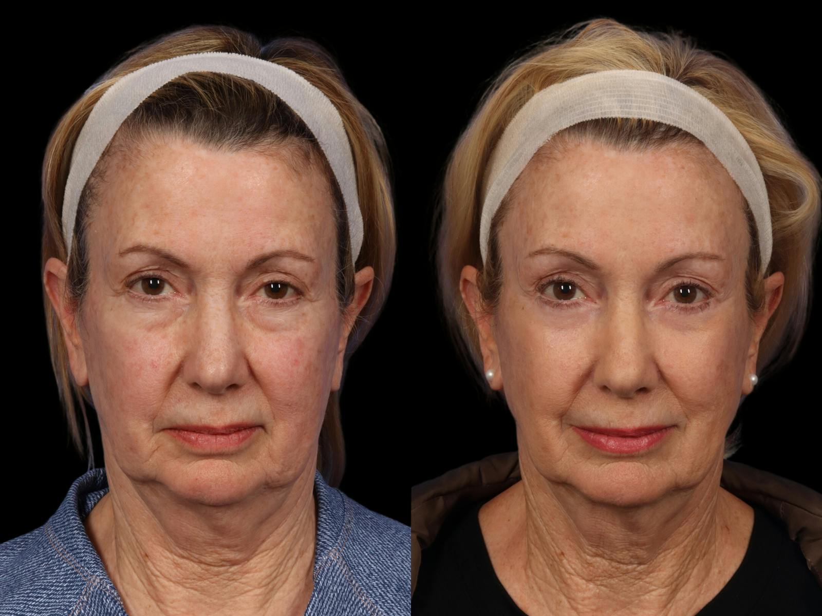 Blepharoplasty Before & After Gallery - Patient 353874 - Image 1