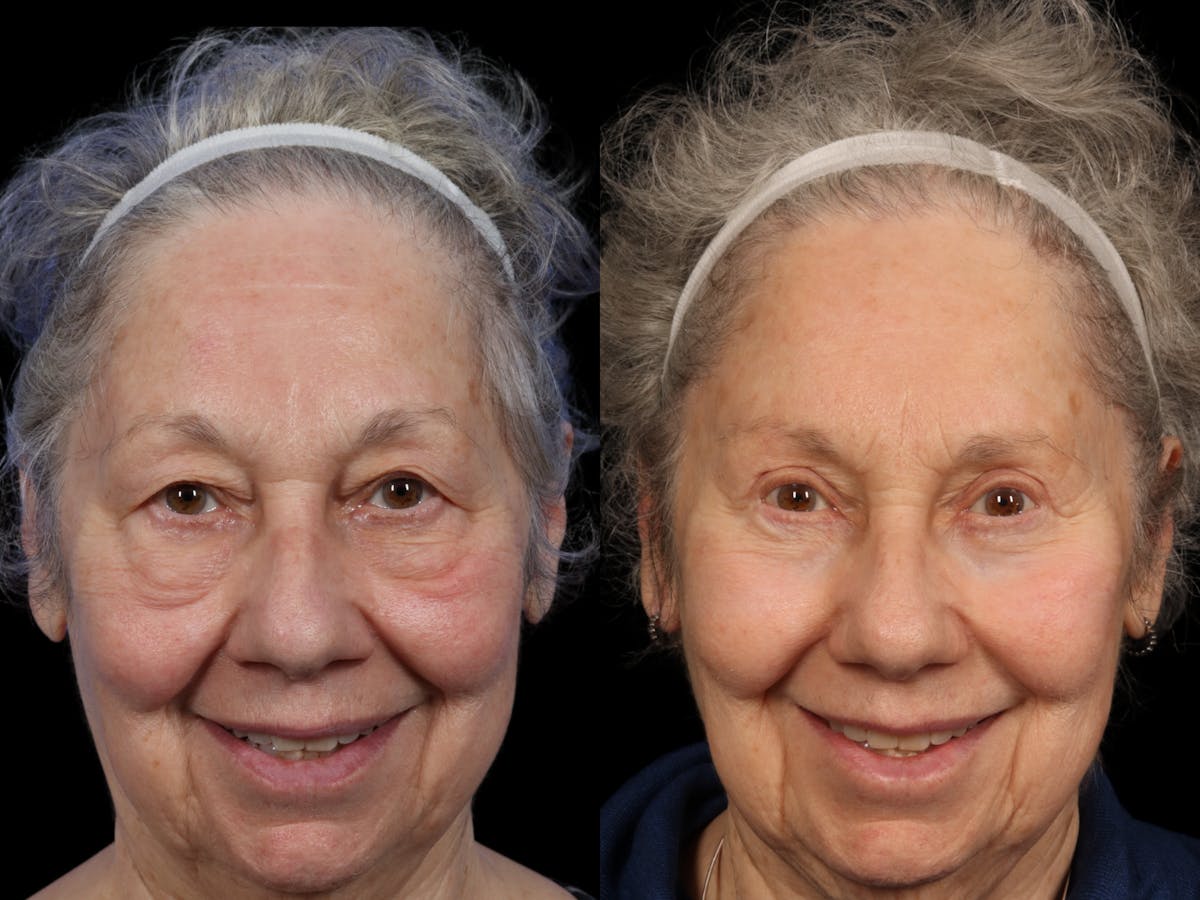 Brow Lift Before & After Gallery - Patient 994319 - Image 1