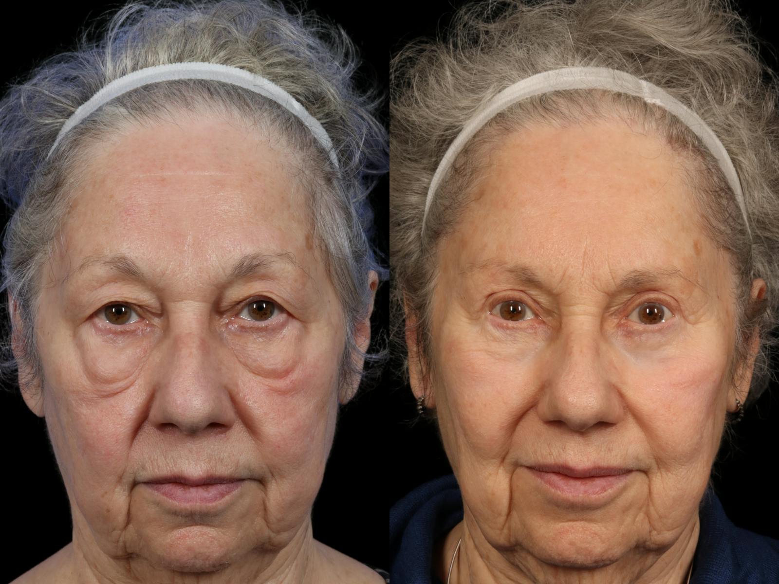 Mid Facelift Before & After Gallery - Patient 889048 - Image 2