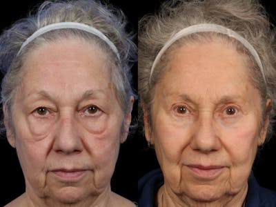 Mid Facelift Before & After Gallery - Patient 889048 - Image 2