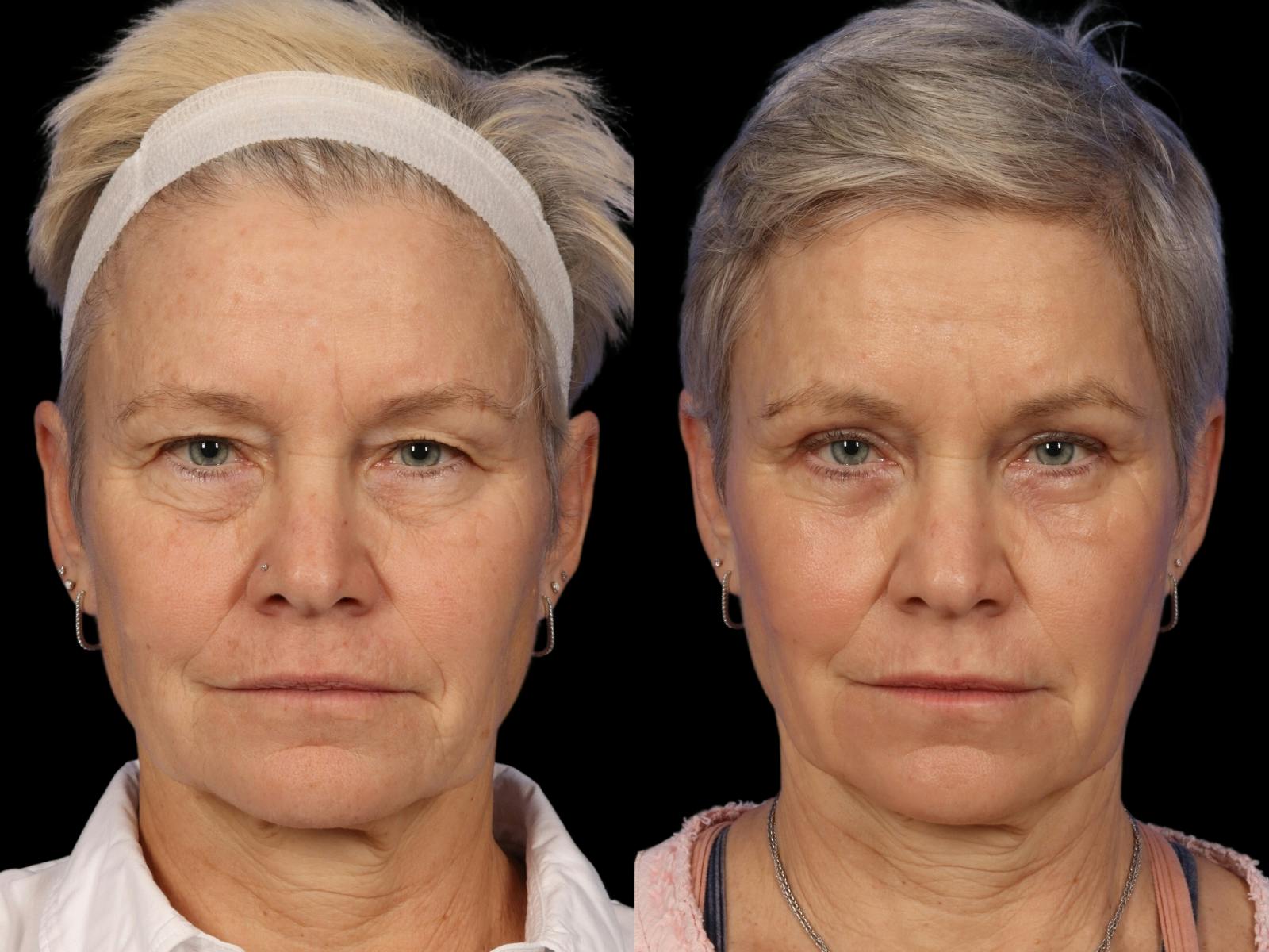 Blepharoplasty Before & After Gallery - Patient 281200 - Image 1