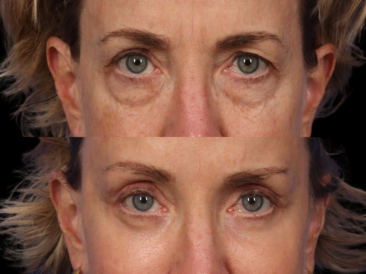 Blepharoplasty Before & After Gallery - Patient 424165 - Image 1