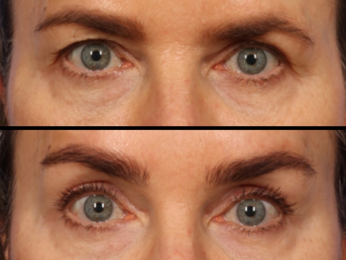 Brow Lift Before & After Gallery - Patient 814986 - Image 2
