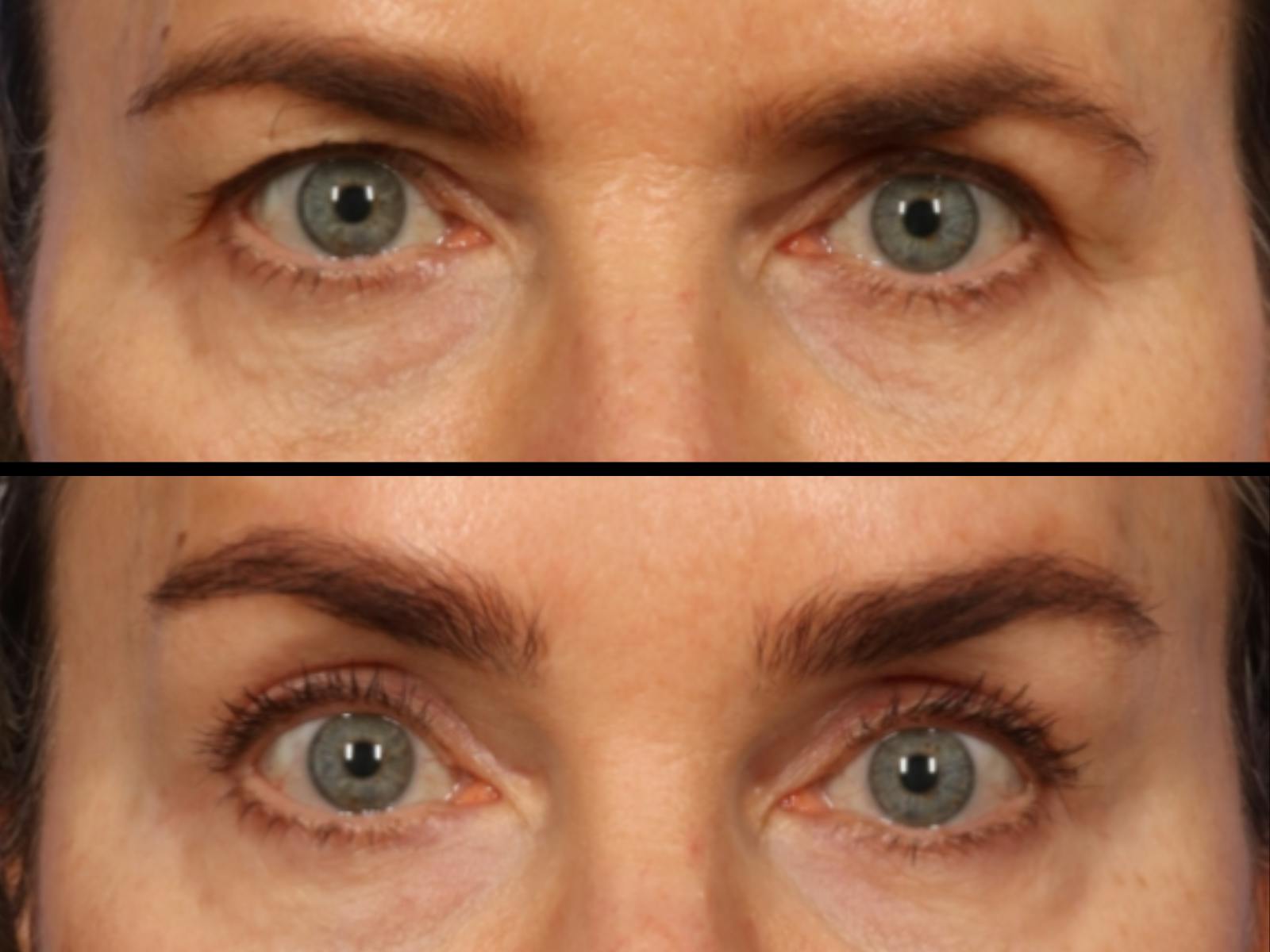 Brow Lift Before & After Gallery - Patient 814986 - Image 2