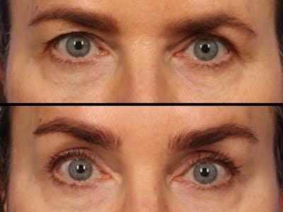 Blepharoplasty Before & After Gallery - Patient 389497 - Image 1