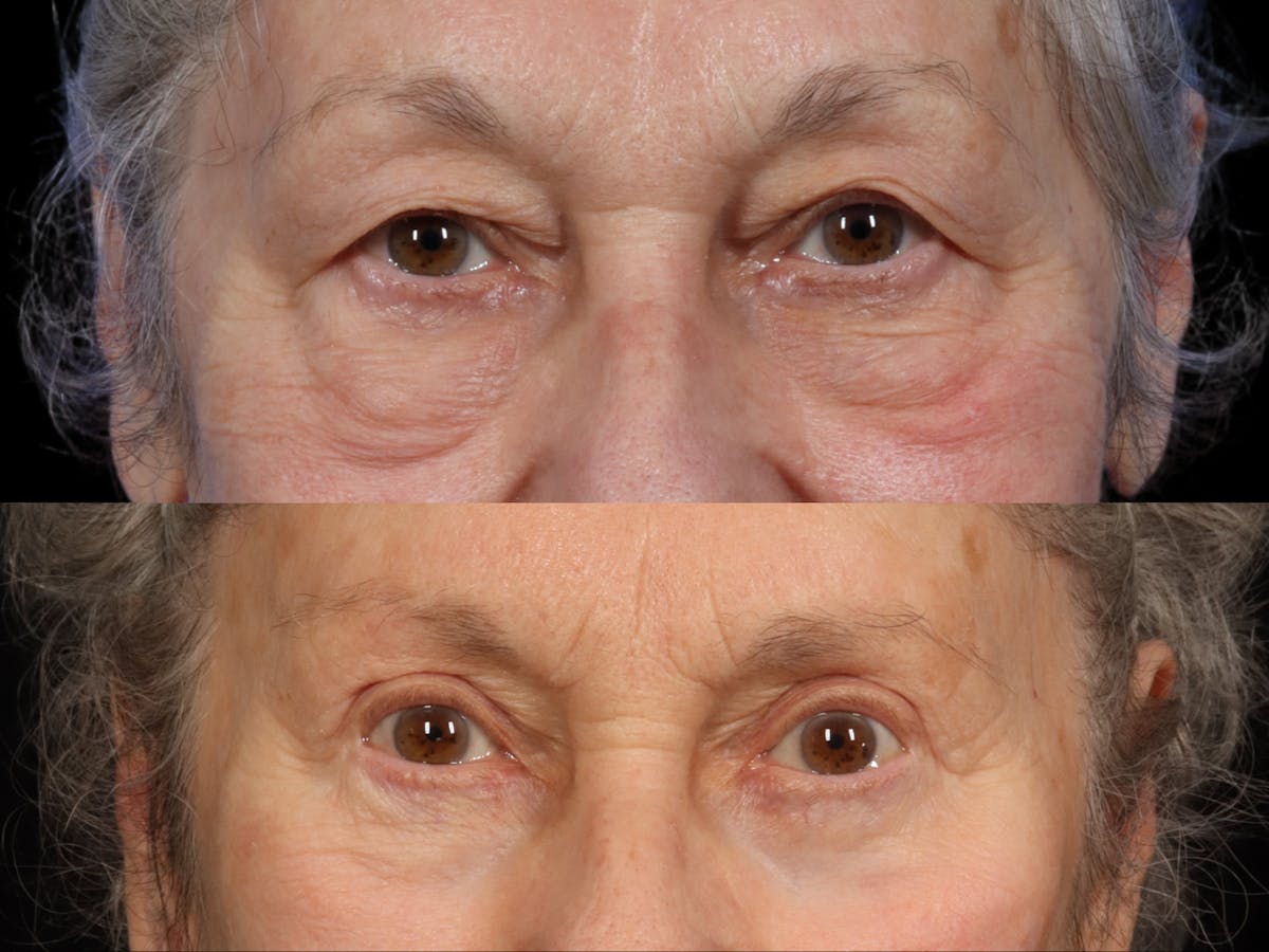 Brow Lift Before & After Gallery - Patient 994319 - Image 2