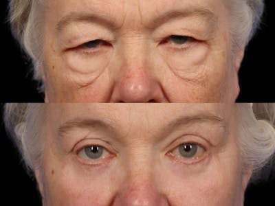 Brow Lift Before & After Gallery - Patient 306843 - Image 1