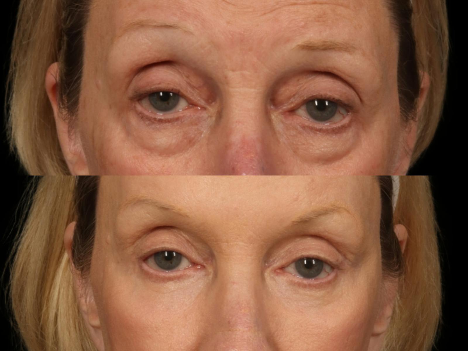 Blepharoplasty Before & After Gallery - Patient 232542 - Image 2
