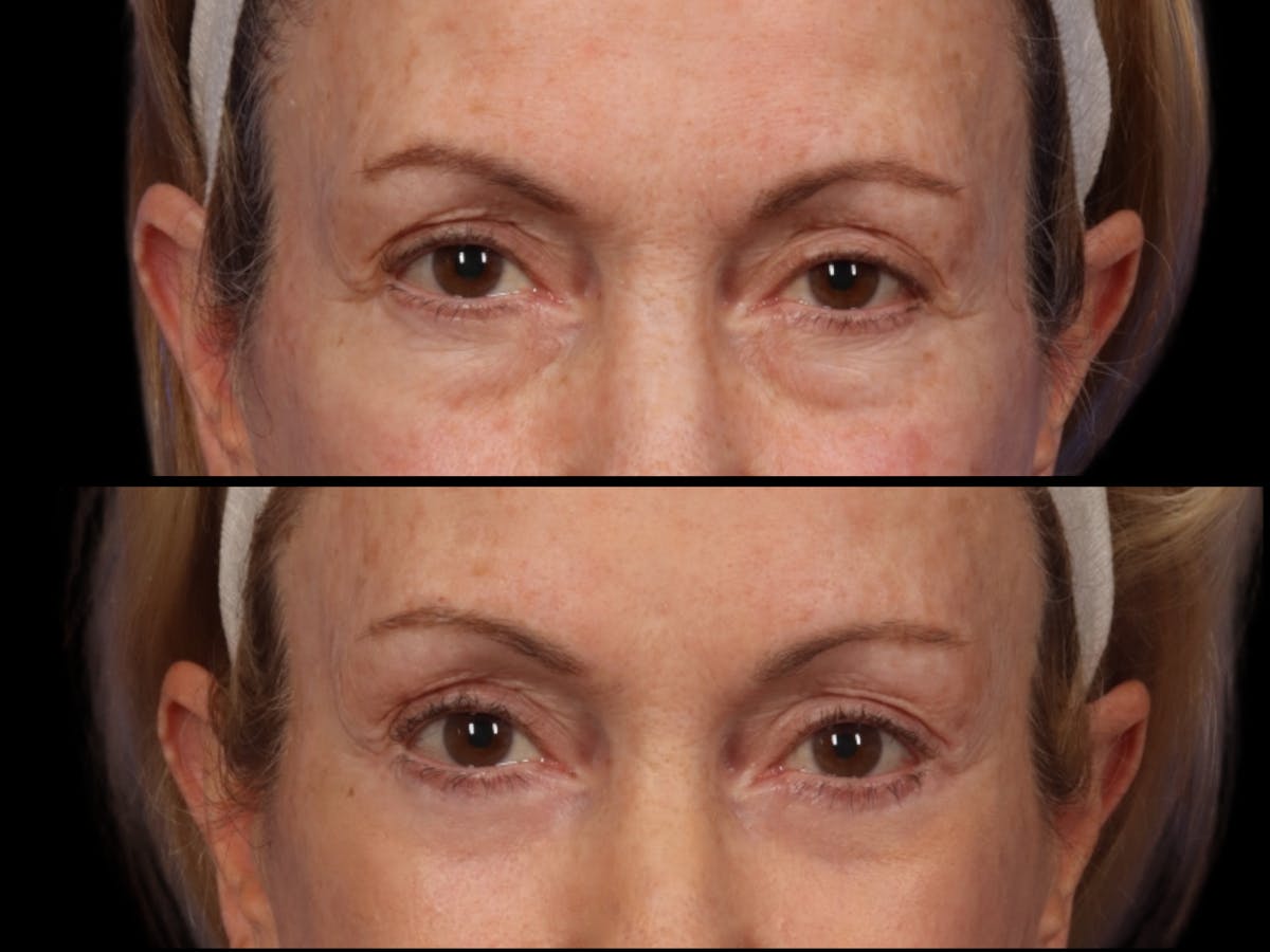 Blepharoplasty Before & After Gallery - Patient 170508 - Image 2
