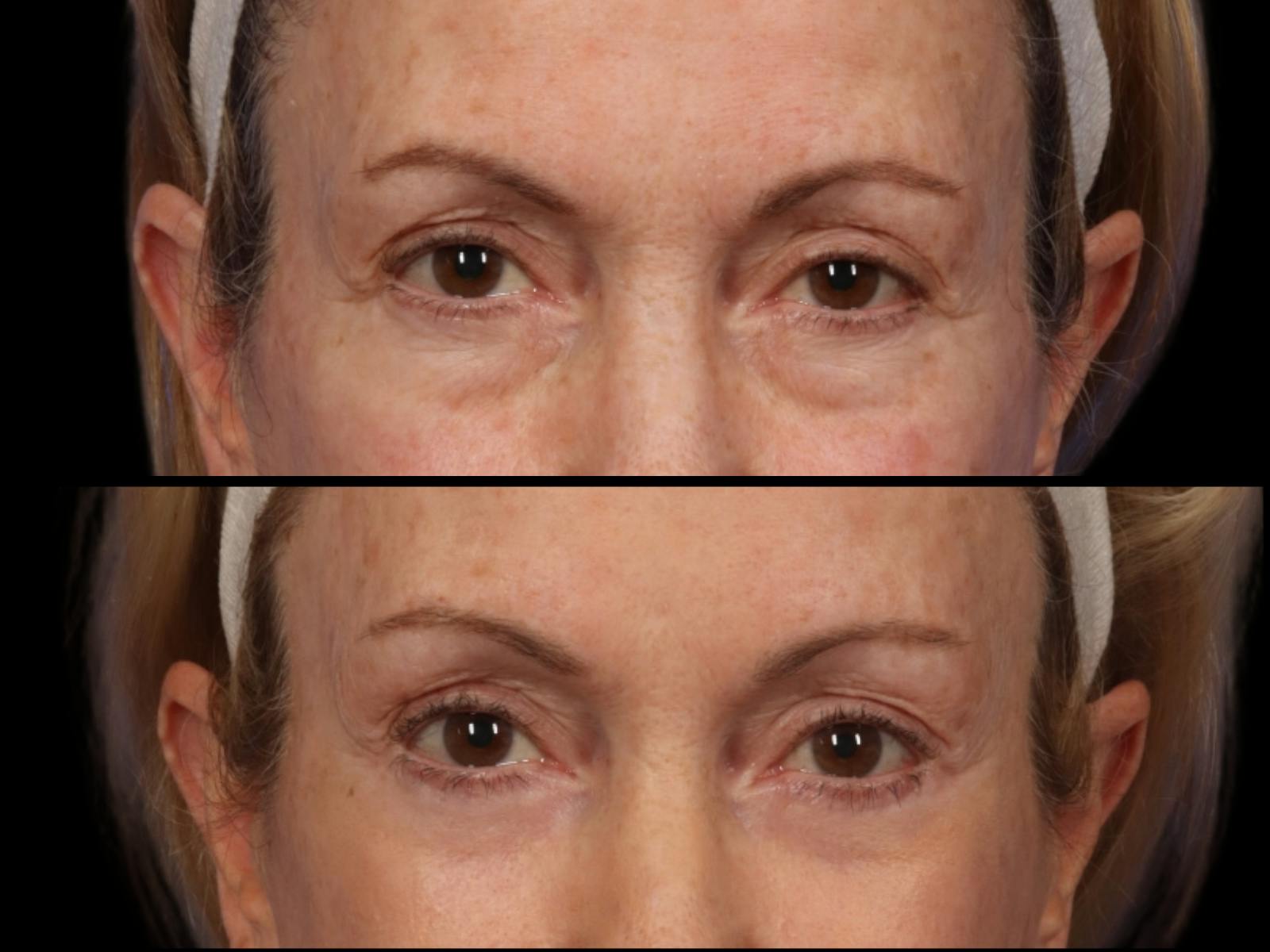 Blepharoplasty Before & After Gallery - Patient 353874 - Image 2