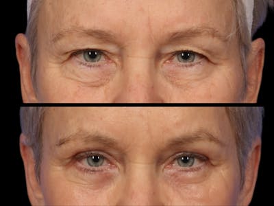 Blepharoplasty Before & After Gallery - Patient 281200 - Image 2