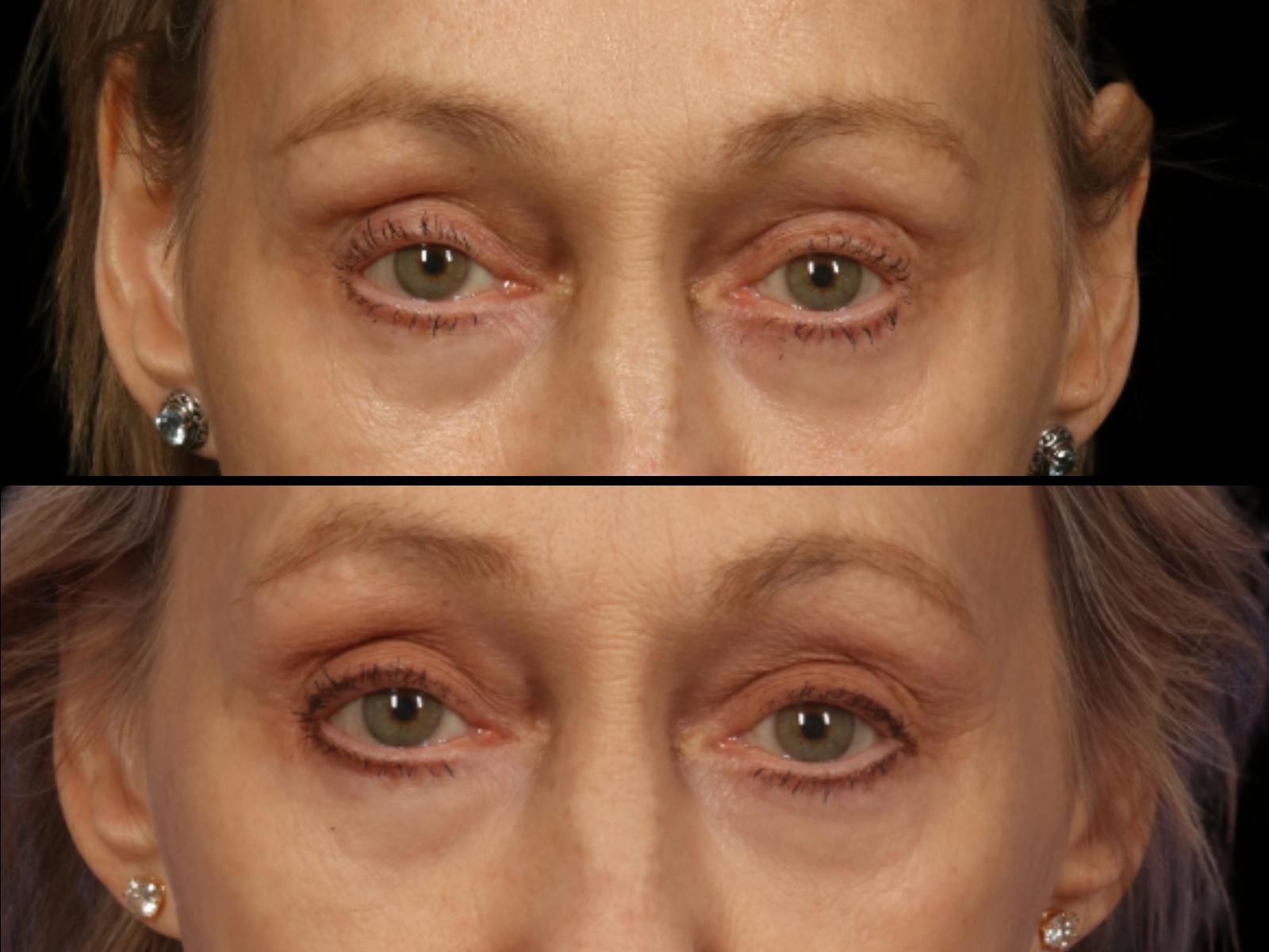 Blepharoplasty Before & After Gallery - Patient 256432 - Image 2