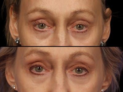 Blepharoplasty Before & After Gallery - Patient 256432 - Image 2