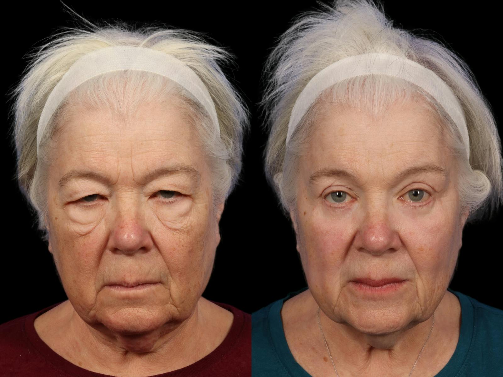 Blepharoplasty Before & After Gallery - Patient 425305 - Image 1