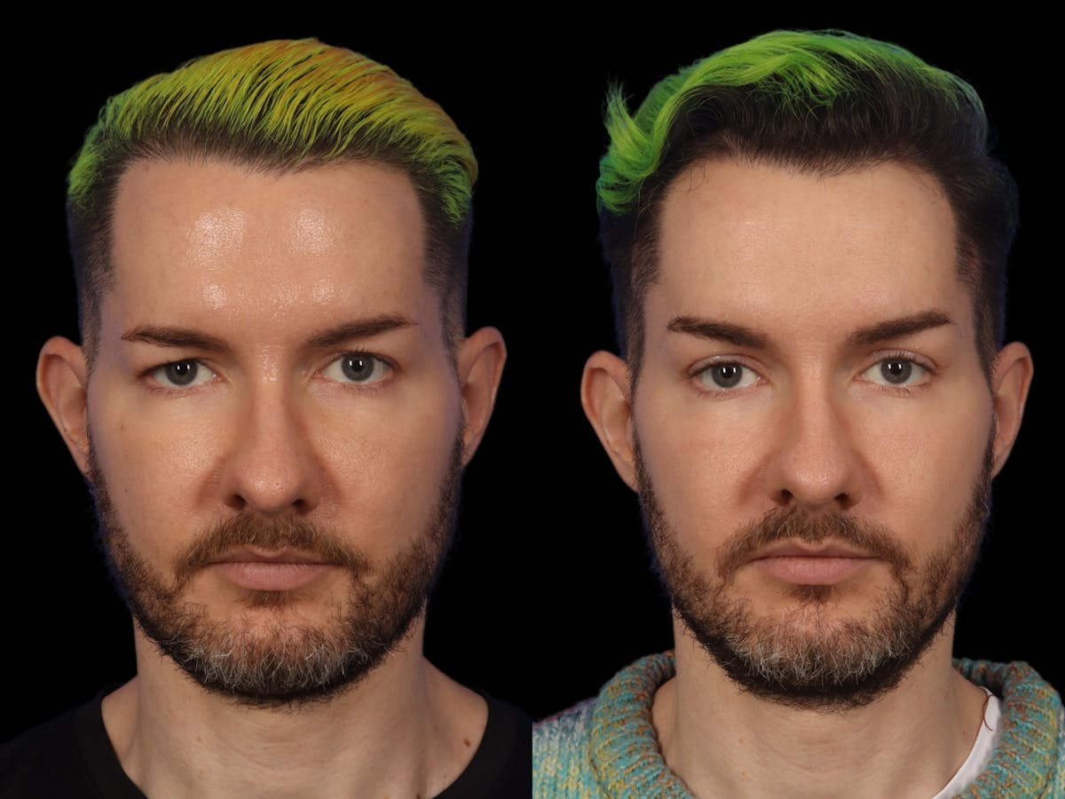 Blepharoplasty Before & After Gallery - Patient 338553 - Image 1