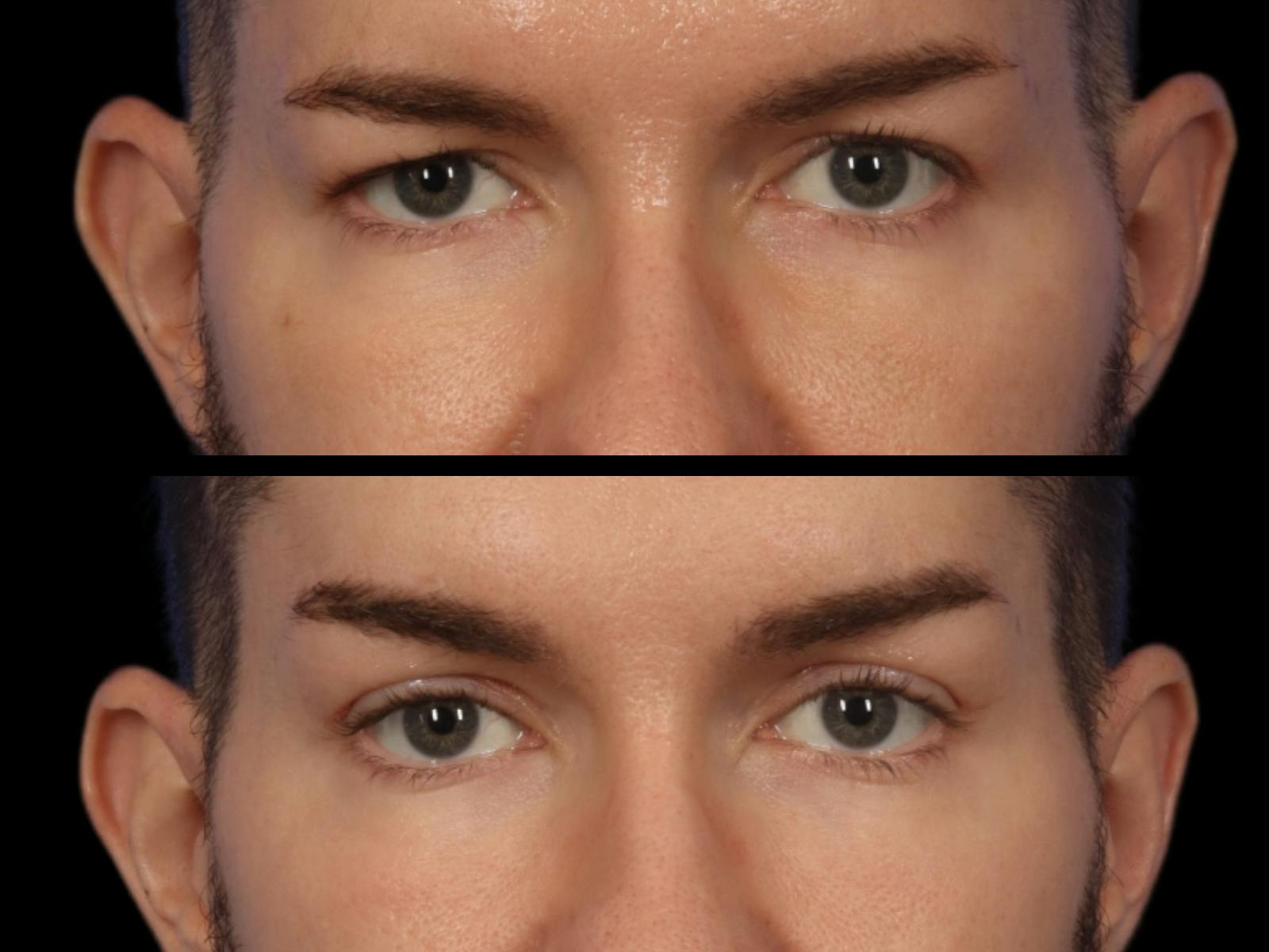 Blepharoplasty Before & After Gallery - Patient 338553 - Image 2