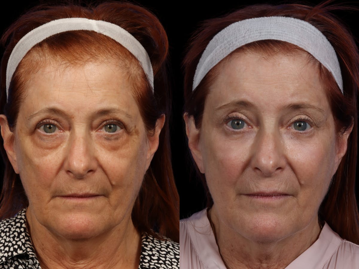 Liposculpture Before & After Gallery - Patient 327023 - Image 1
