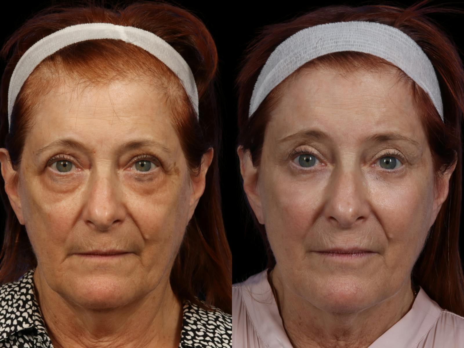 Brow Lift Before & After Gallery - Patient 154825 - Image 1