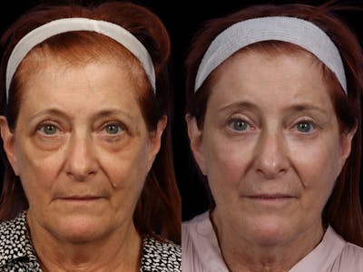 Fillers Before & After Gallery - Patient 704037 - Image 1
