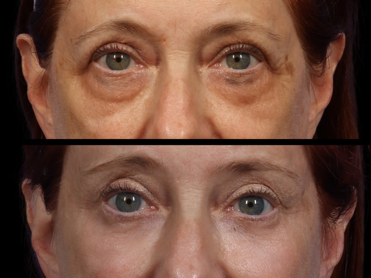 Blepharoplasty Before & After Gallery - Patient 244744 - Image 2