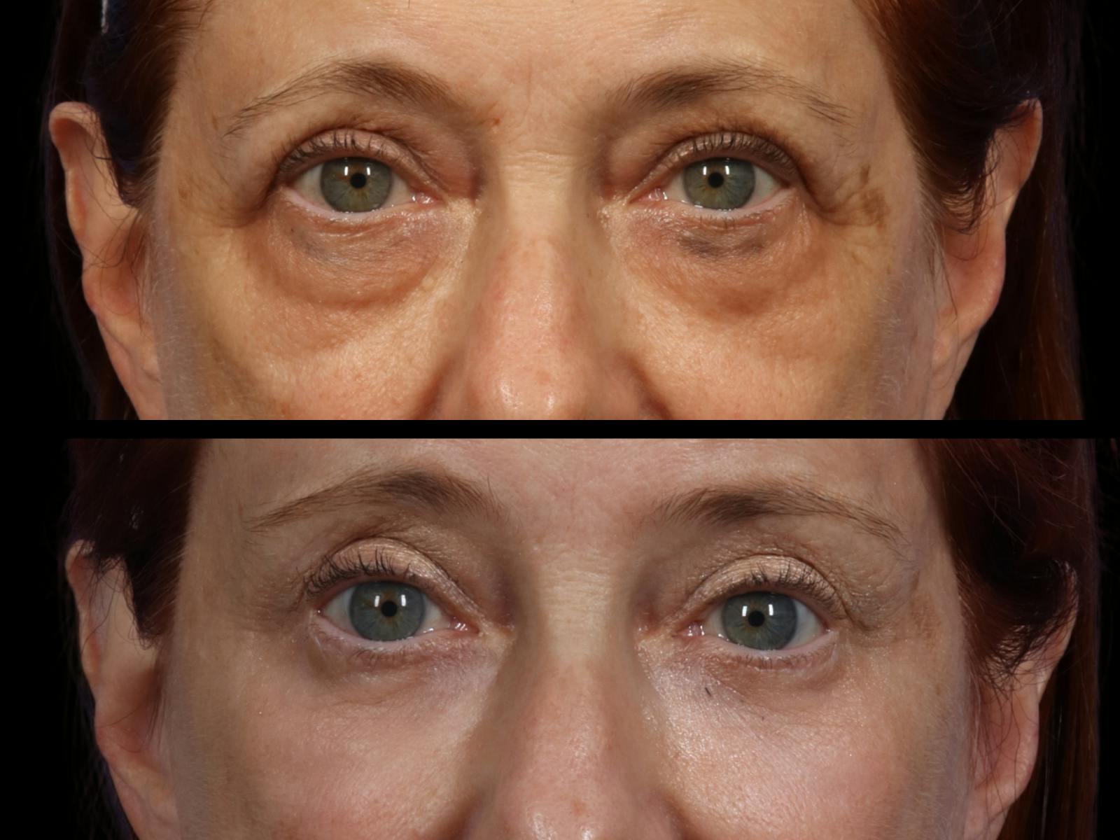 Blepharoplasty Before & After Gallery - Patient 244744 - Image 2