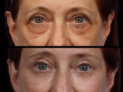 Blepharoplasty Before & After Gallery - Patient 244744 - Image 2