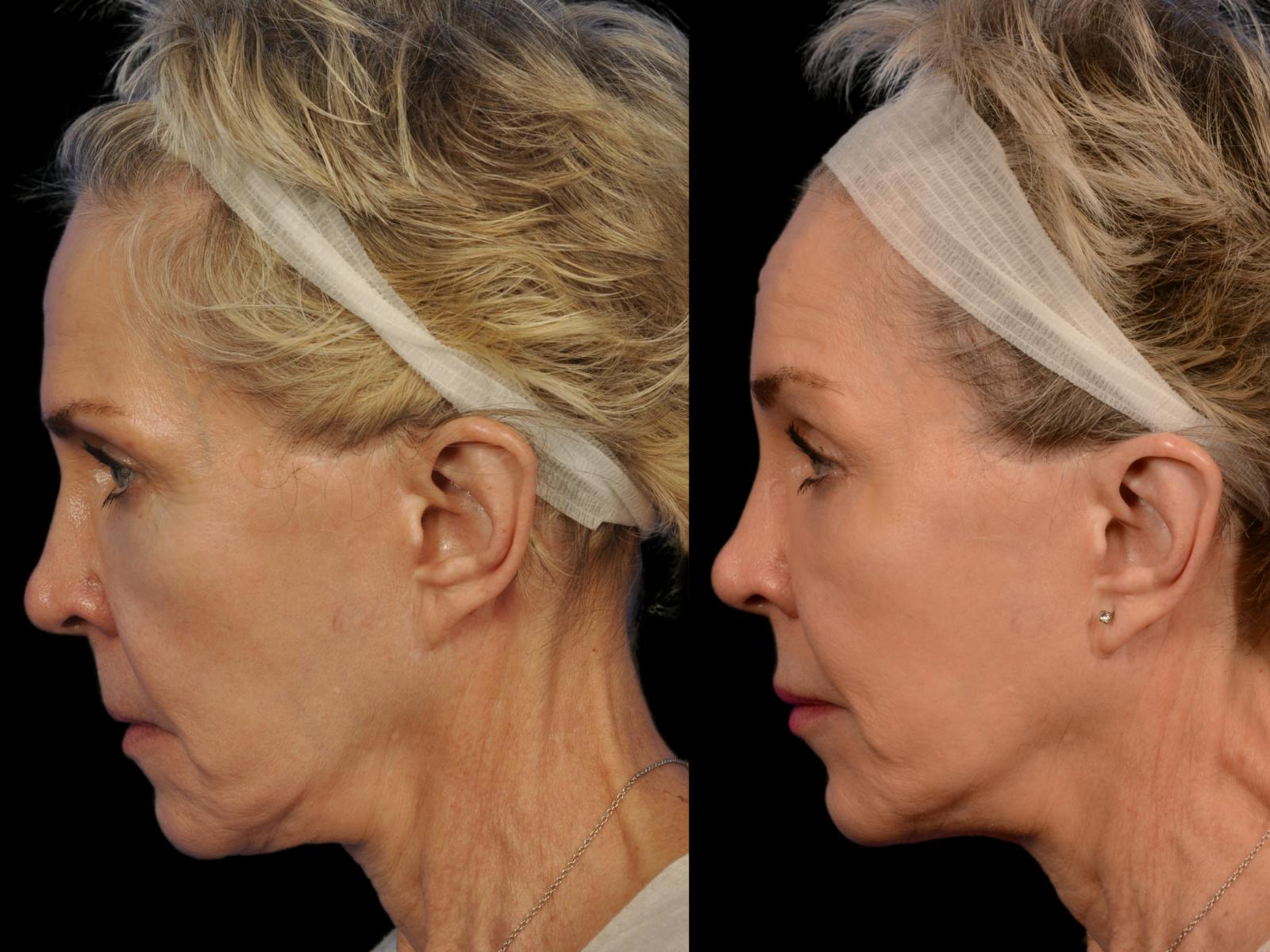 Liposculpture Before & After Gallery - Patient 236997 - Image 5