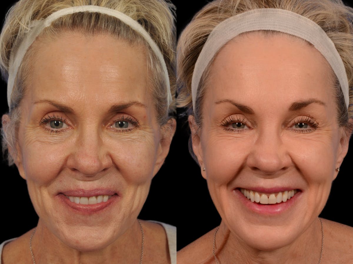 Liposculpture Before & After Gallery - Patient 236997 - Image 2