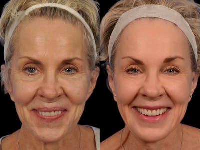 Blepharoplasty Before & After Gallery - Patient 366030 - Image 1