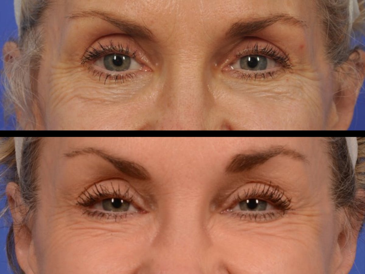 Liposculpture Before & After Gallery - Patient 236997 - Image 1