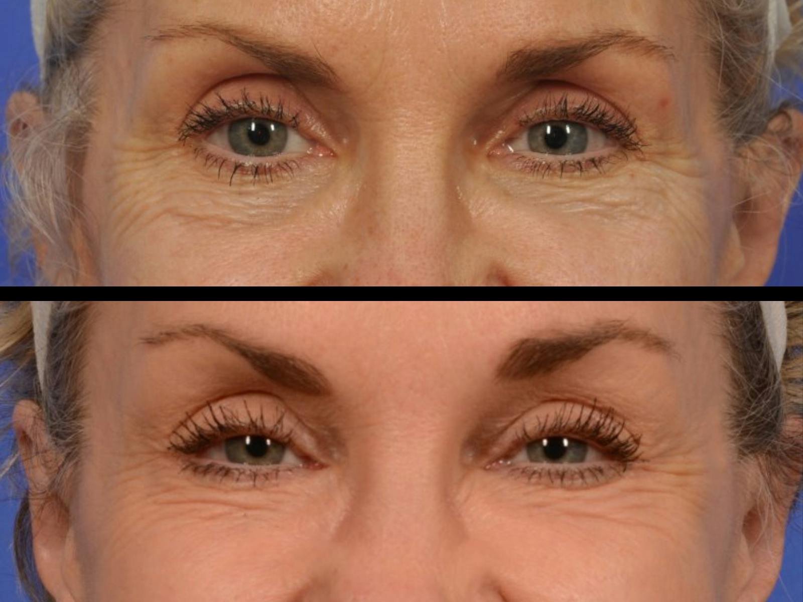 Liposculpture Before & After Gallery - Patient 236997 - Image 2