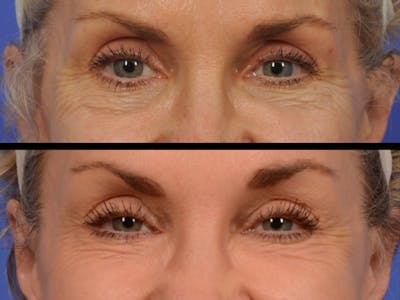 Fillers Before & After Gallery - Patient 116947 - Image 1
