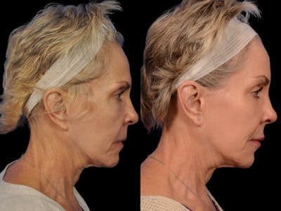 Mid Facelift Before & After Gallery - Patient 283809 - Image 3