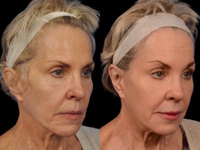 Mid Facelift Before & After Gallery - Patient 283809 - Image 2