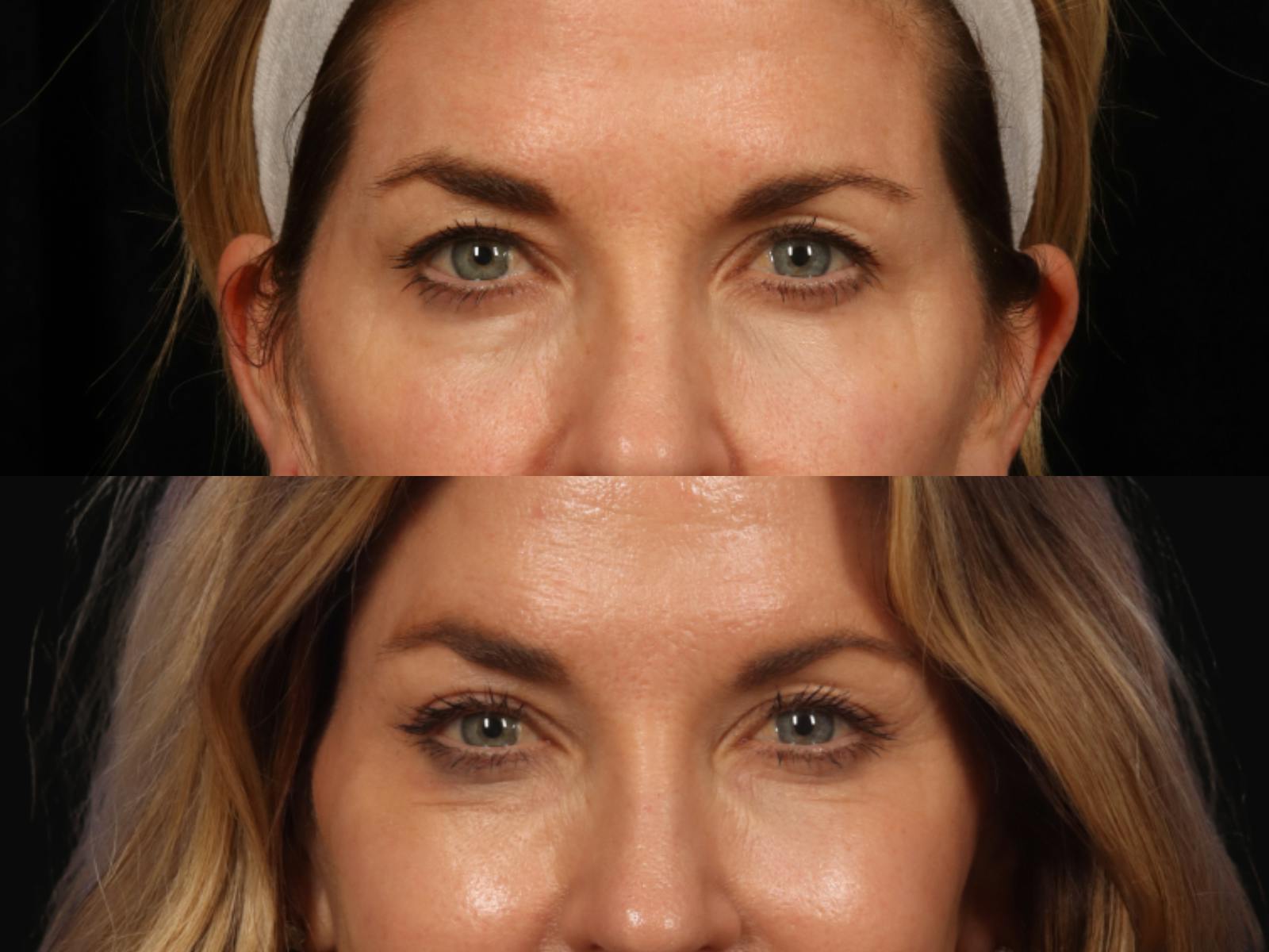 Blepharoplasty Before & After Gallery - Patient 351061 - Image 2