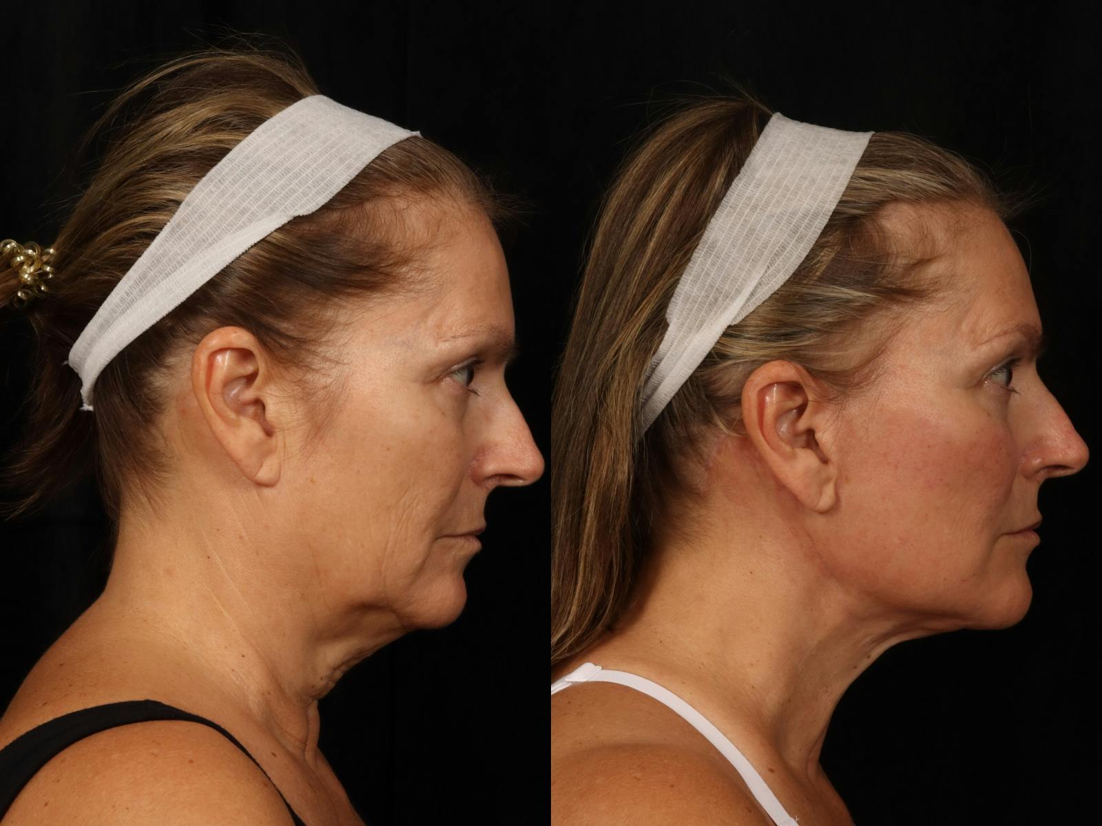 Facelift Before & After Gallery - Patient 319584 - Image 4