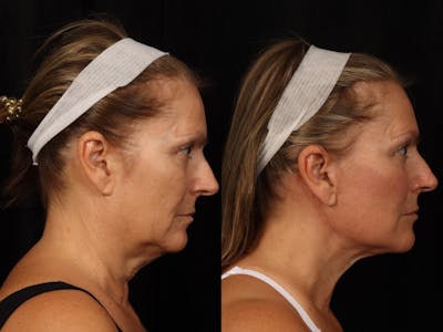 Facelift Before & After Gallery - Patient 319584 - Image 4